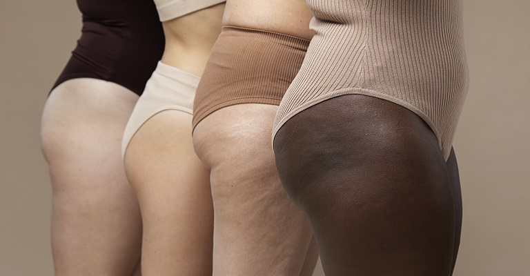Lipedema: mitos e verdades sobre essa condição