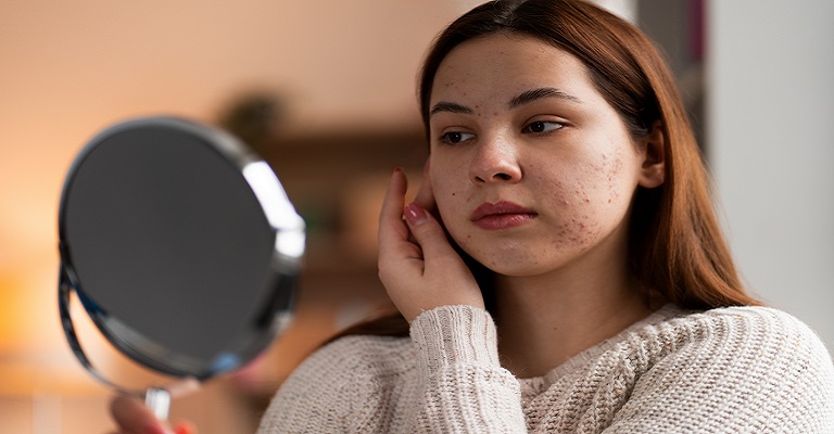 O que é hidradenite supurativa? Conheça os sintomas, riscos e tratamentos