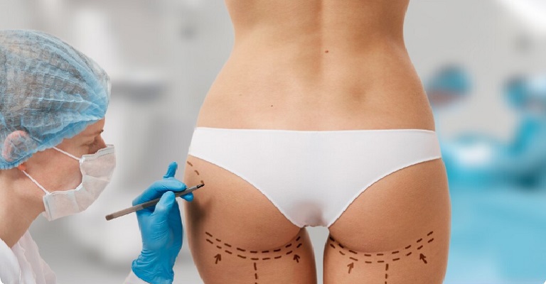 Preenchimento de glúteos: chegada do verão aumenta a procura por procedimentos